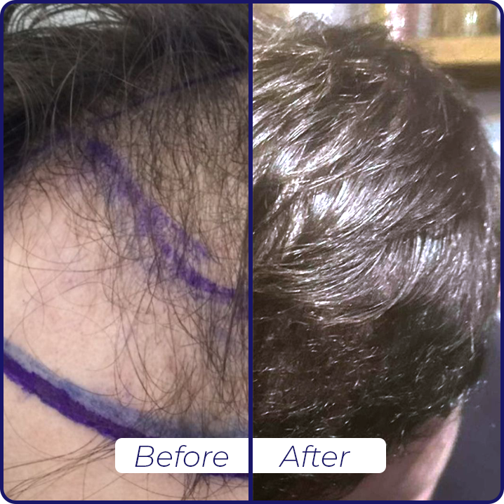 hair transplant before and after