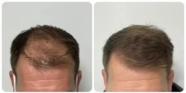 Day 0: The Day of Hair Transplant Surgery