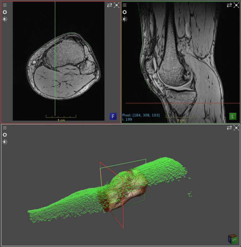 3D surface registered to a knee MRI volume