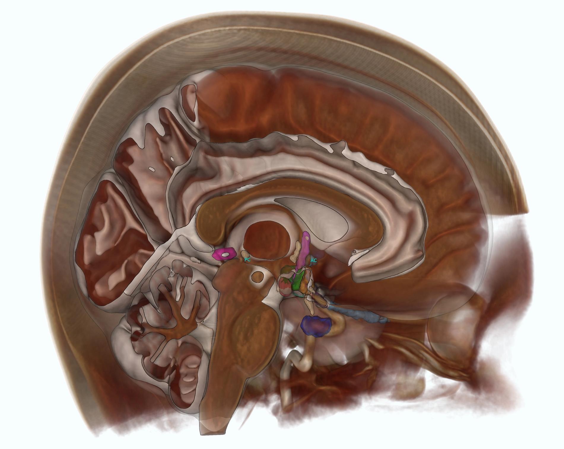 Cranial vessel graph from contrast-enhanced MRI
