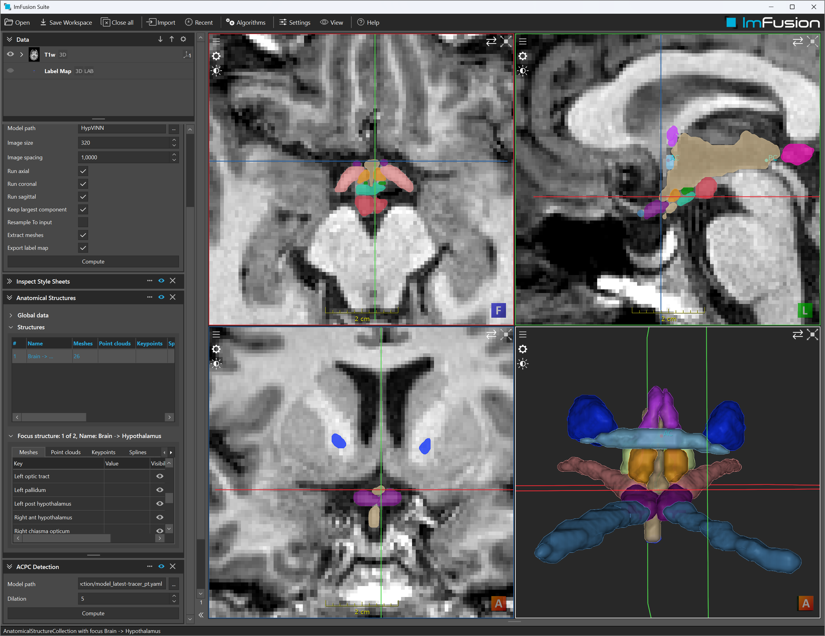 Hypothalamus substructure segmentation in the shared cranial anatomy model