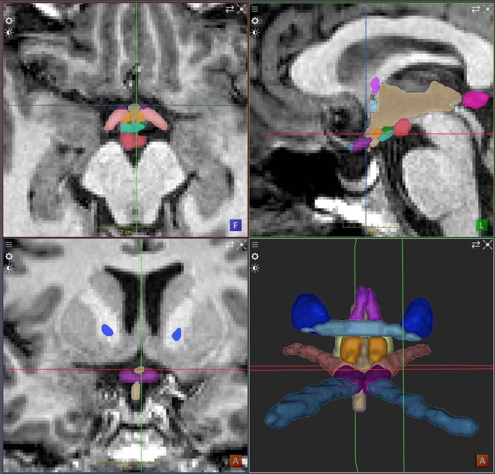 Hypothalamus substructure segmentation in the shared cranial anatomy model