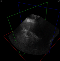 Live compounding of a freehand ultrasound sweep into a 3D volume