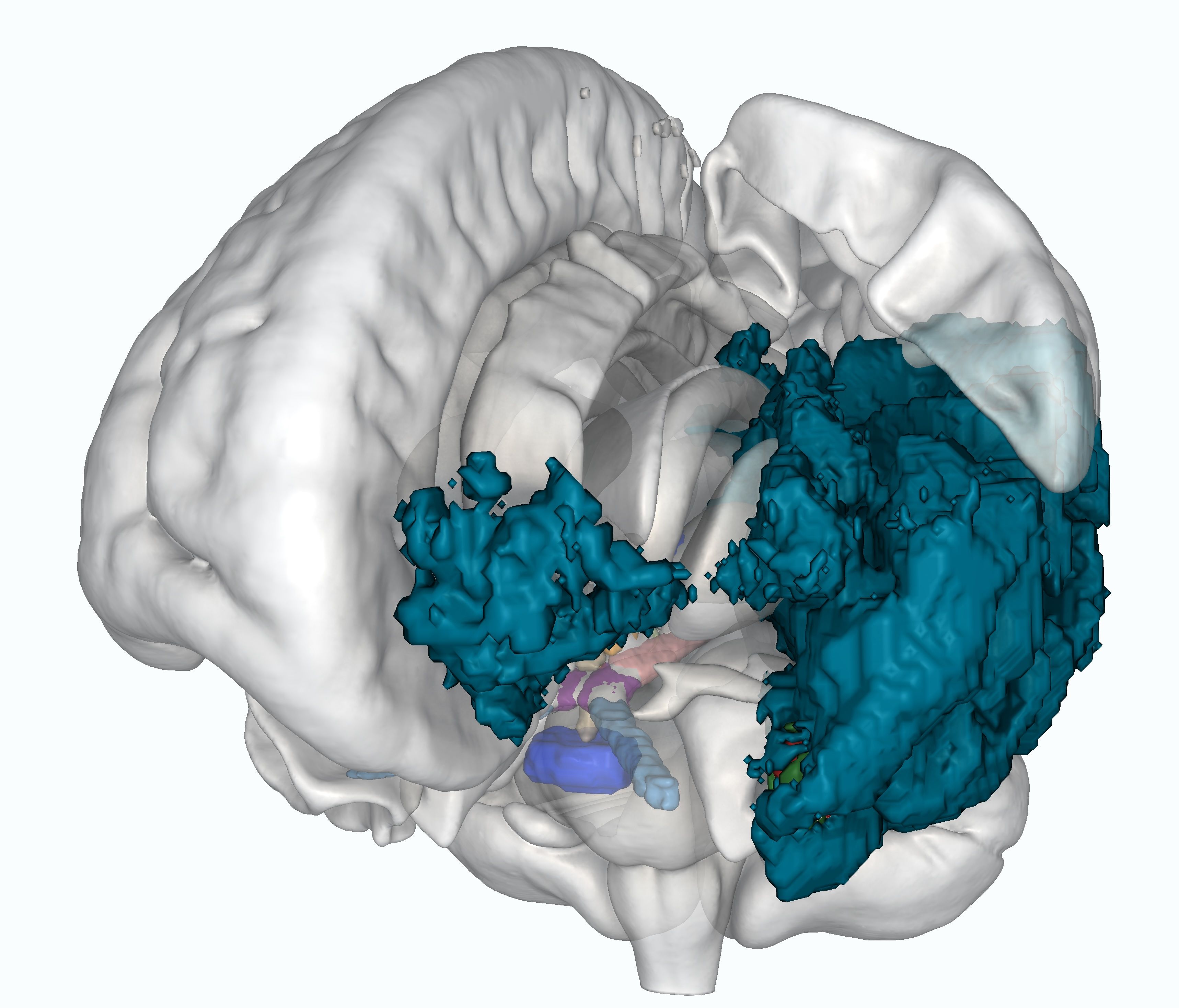 CT skull and craniofacial bone segmentation with tables and fixtures removed