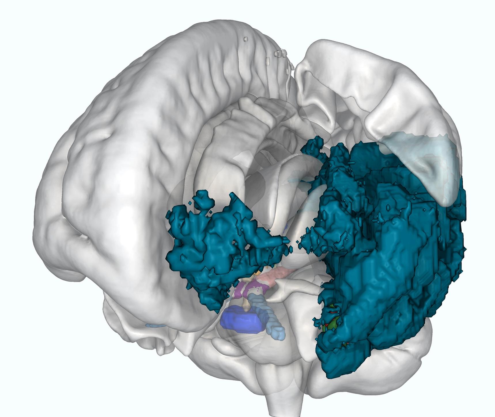 CT skull and craniofacial bone segmentation with tables and fixtures removed