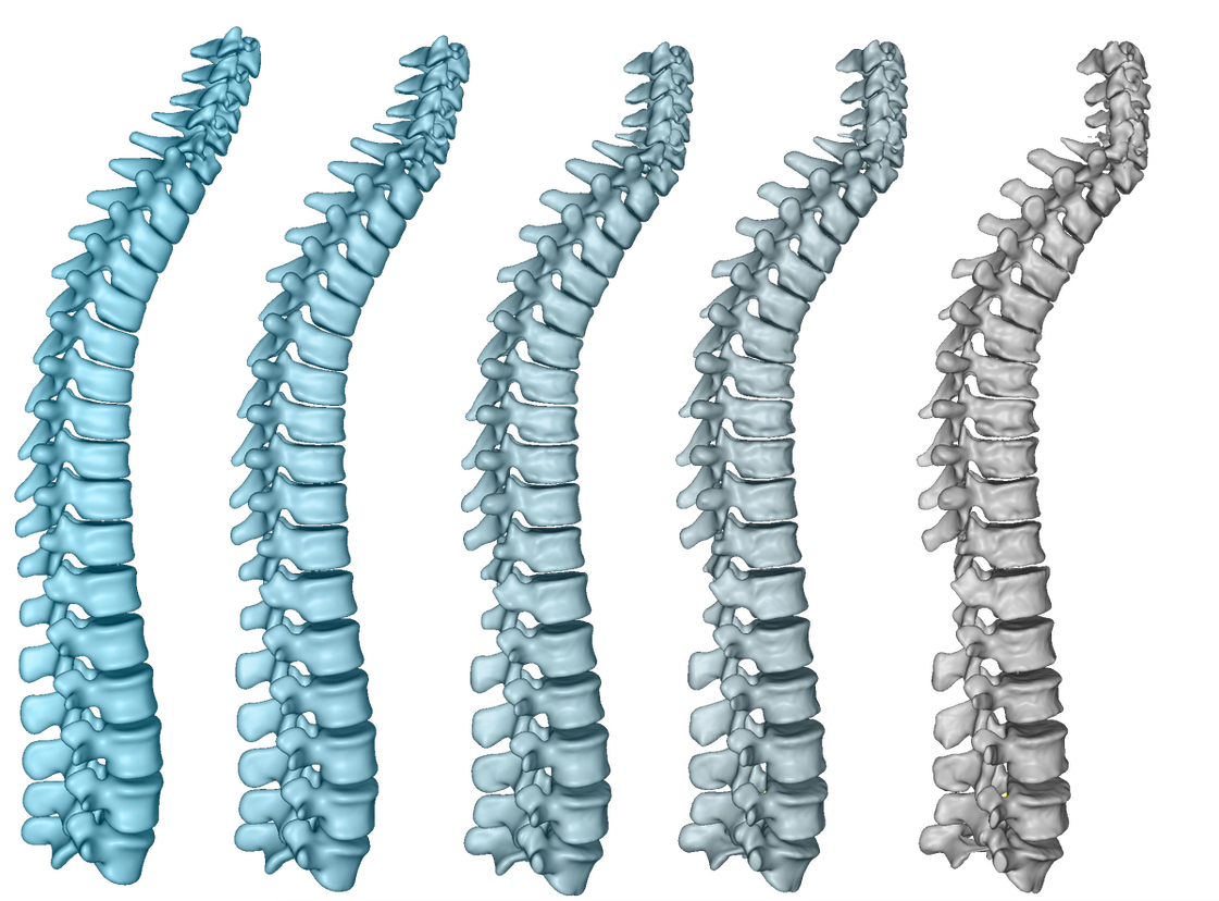 Deformable spine-to-spine registration