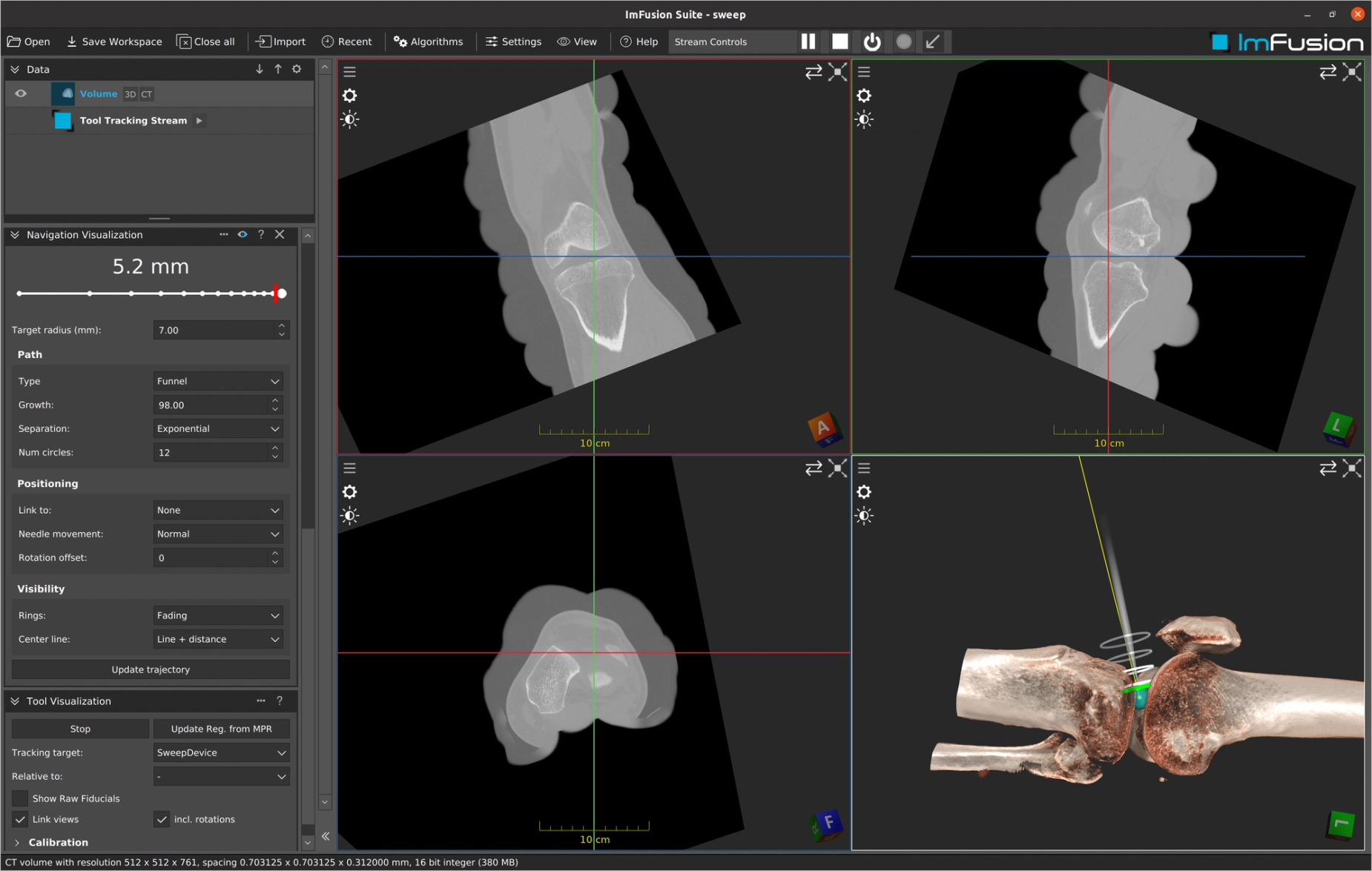 Target fading visualization on a registered 3D anatomy