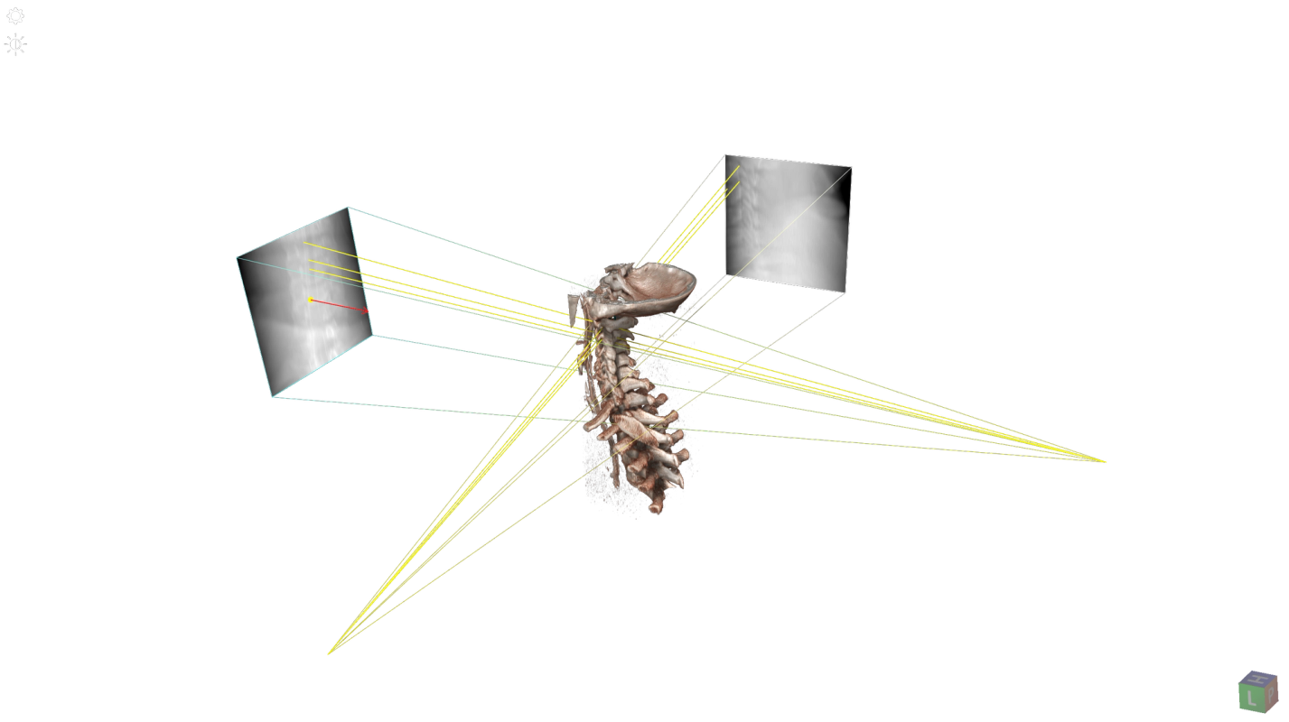 2D/3D registration aligning live X-ray with a CT volume