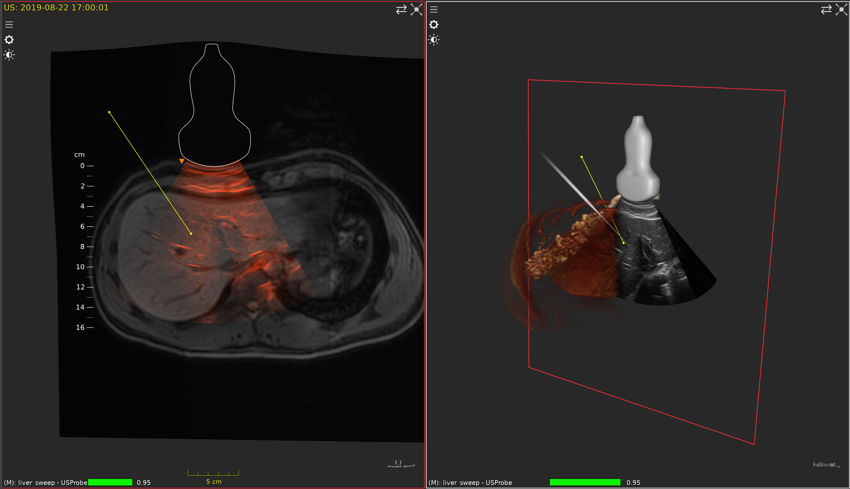 Live ultrasound fused with a 3D liver volume and a tracked needle trajectory