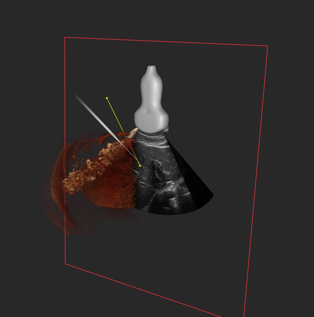 Live ultrasound fused with a 3D liver volume and a tracked needle trajectory