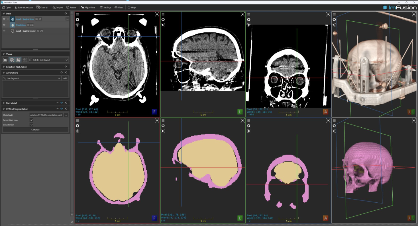 CT skull and craniofacial bone segmentation with tables and fixtures removed