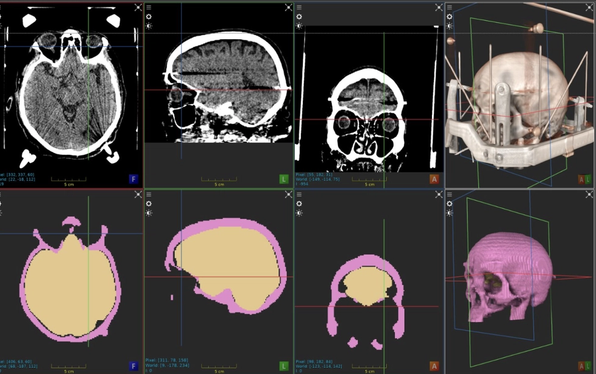 CT skull and craniofacial bone segmentation with tables and fixtures removed