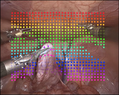 Endoscopic image showing multiple tools handling internals of the body, with an overlay of colourful dots that track the movement of the tools and organs