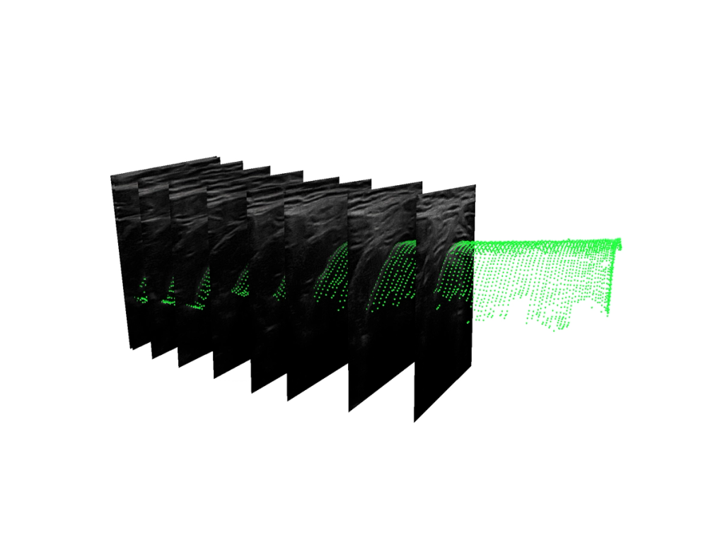 Live ultrasound bone surface segmentation