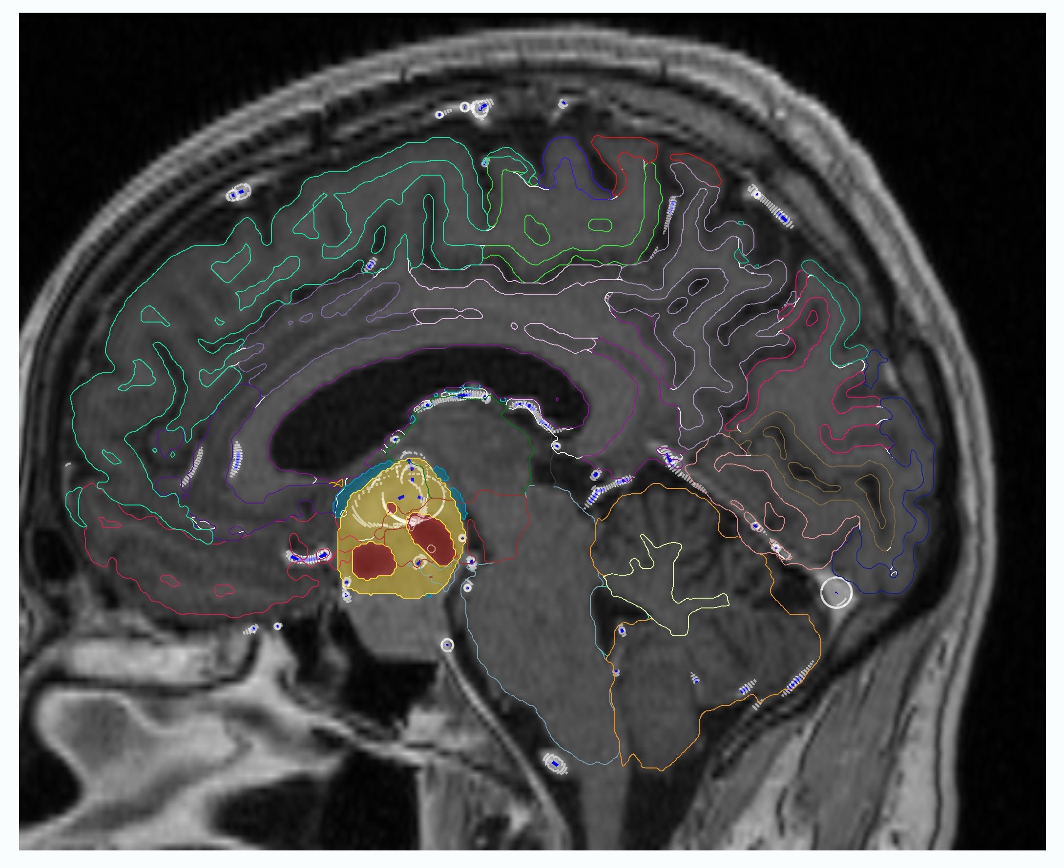 Hypothalamus substructure segmentation in the shared cranial anatomy model