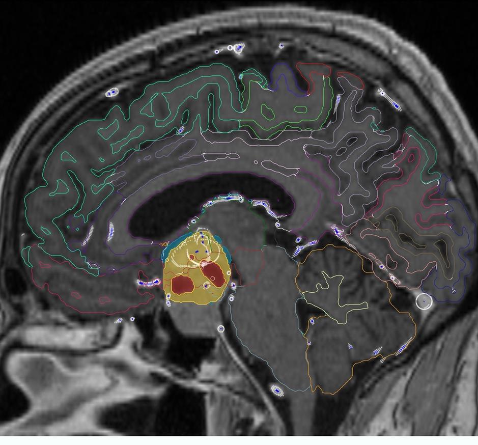 Hypothalamus substructure segmentation in the shared cranial anatomy model