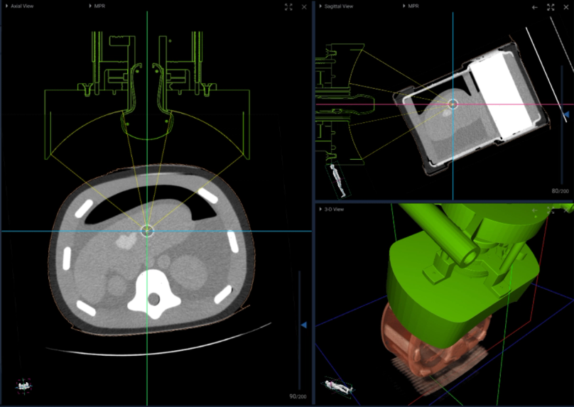 Enabling image guidance for incisionless tumor treatment