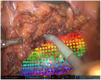 Endoscopic Vision