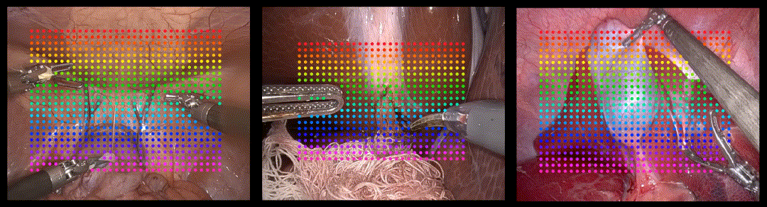 Endoscopic image showing multiple tools handling internals of the body, with an overlay of colourful dots that track the movement of the tools and organs