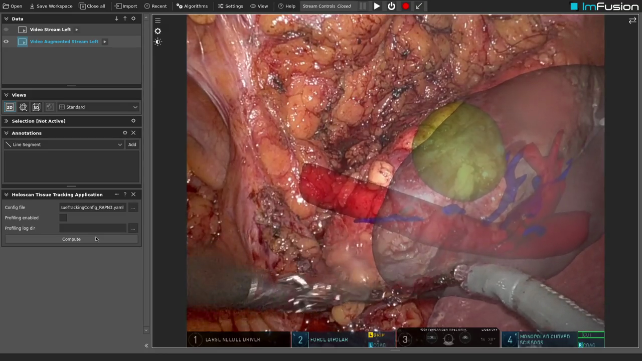 Endoscopic tissue tracking of a pre-op segmentation