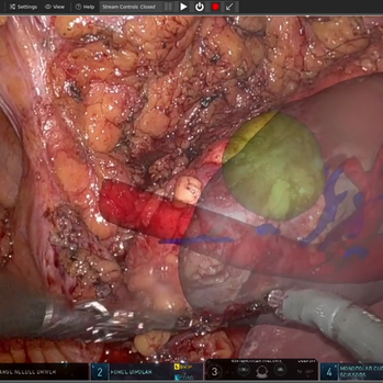 Endoscopic tissue tracking of a pre-op segmentation