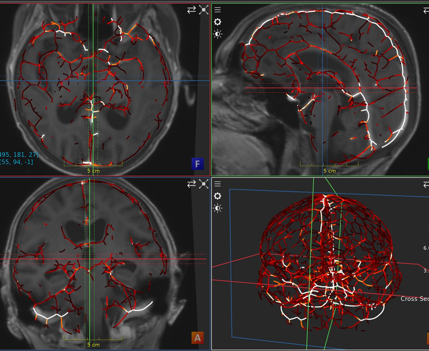 Cranial vessel graph from contrast-enhanced MRI