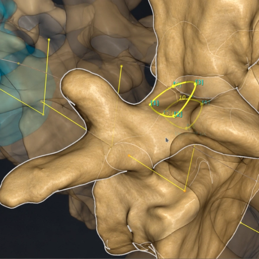 Zoomed in picture of a vertebrae with a cutting path defined by the project SaveCut