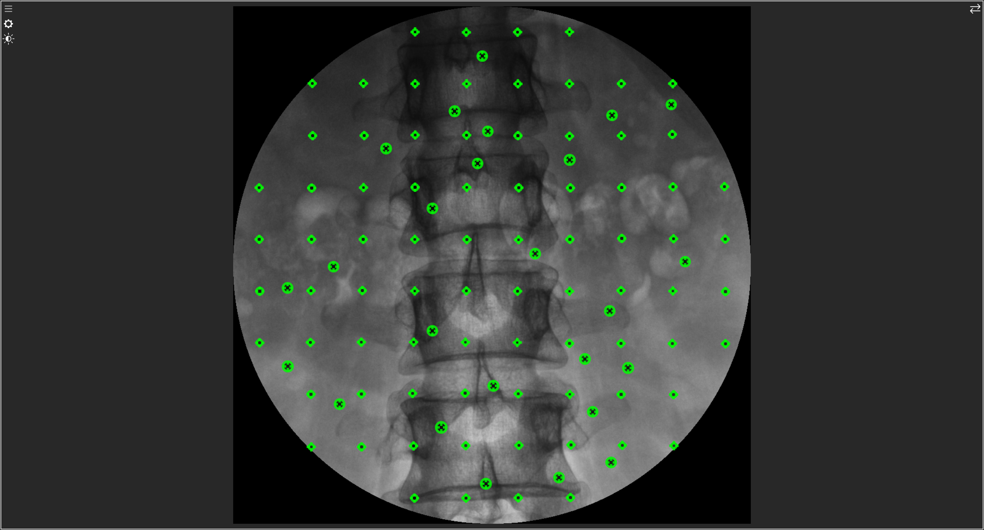fiducial extraction form spine fluoro shot