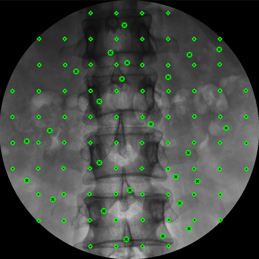 fiducial extraction form spine fluoro shot
