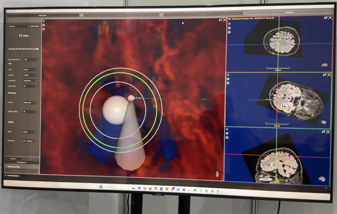 Neuronavigation view fusing cranial anatomy for intra-operative guidance