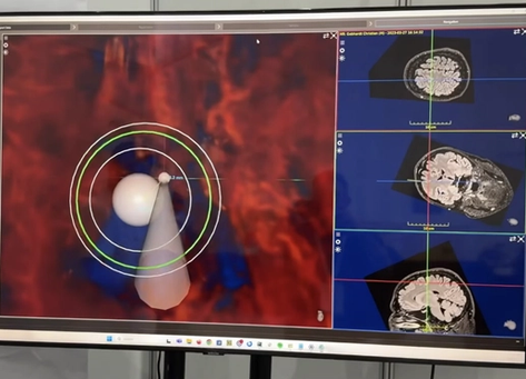Neuronavigation view fusing cranial anatomy for intra-operative guidance