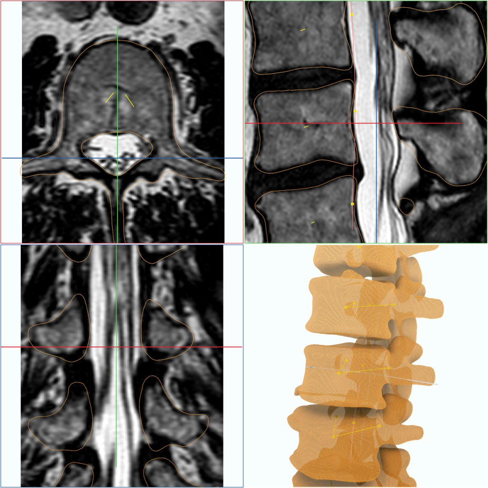 Spine AI pipeline steps from localization through segmentation