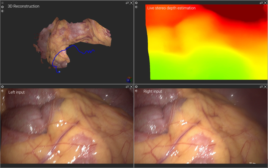Endoscopic SLAM map built from stereo laparoscopic video
