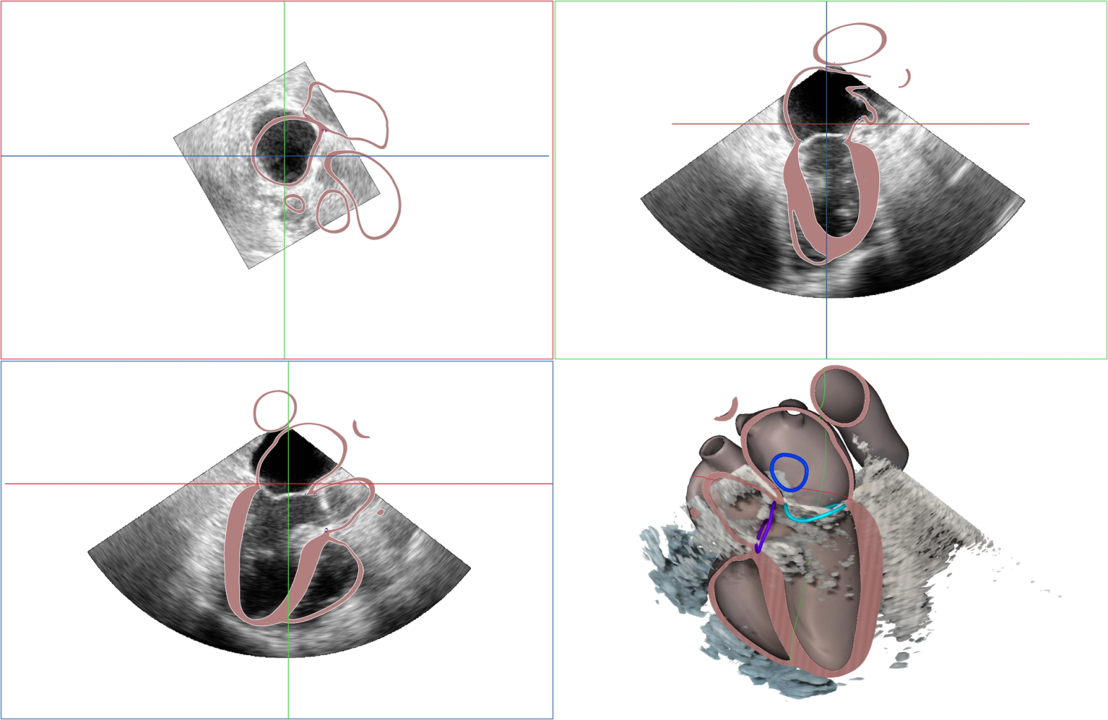 Heart reconstruction in action