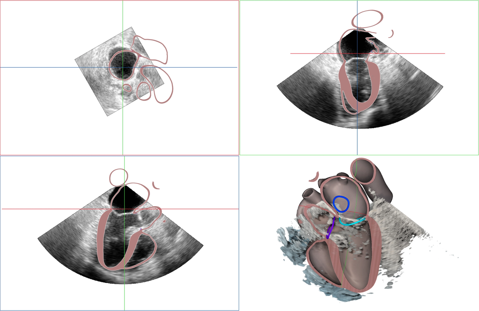 Heart reconstruction in action