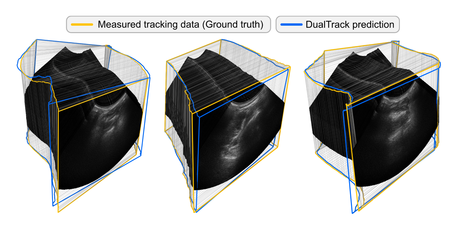 AI-based tracking estimation for freehand ultrasound reconstruction