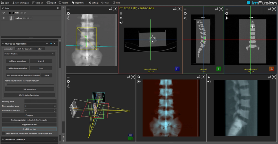 CT to X-ray 2D/3D registration overlay