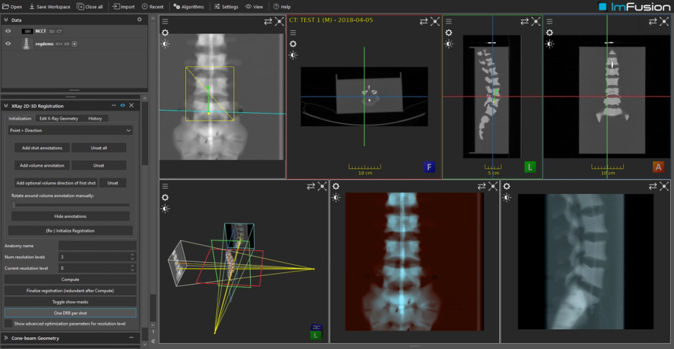 CT to X-ray 2D/3D registration overlay
