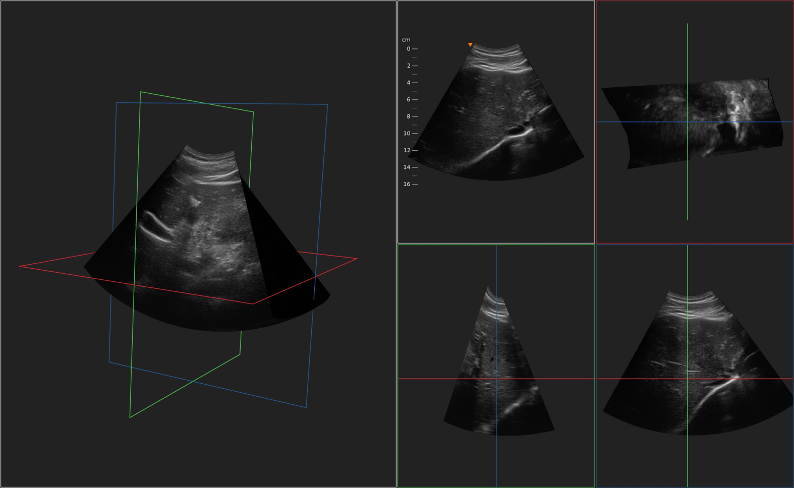 ImFusion Suite during 3D freehand ultrasound calibration