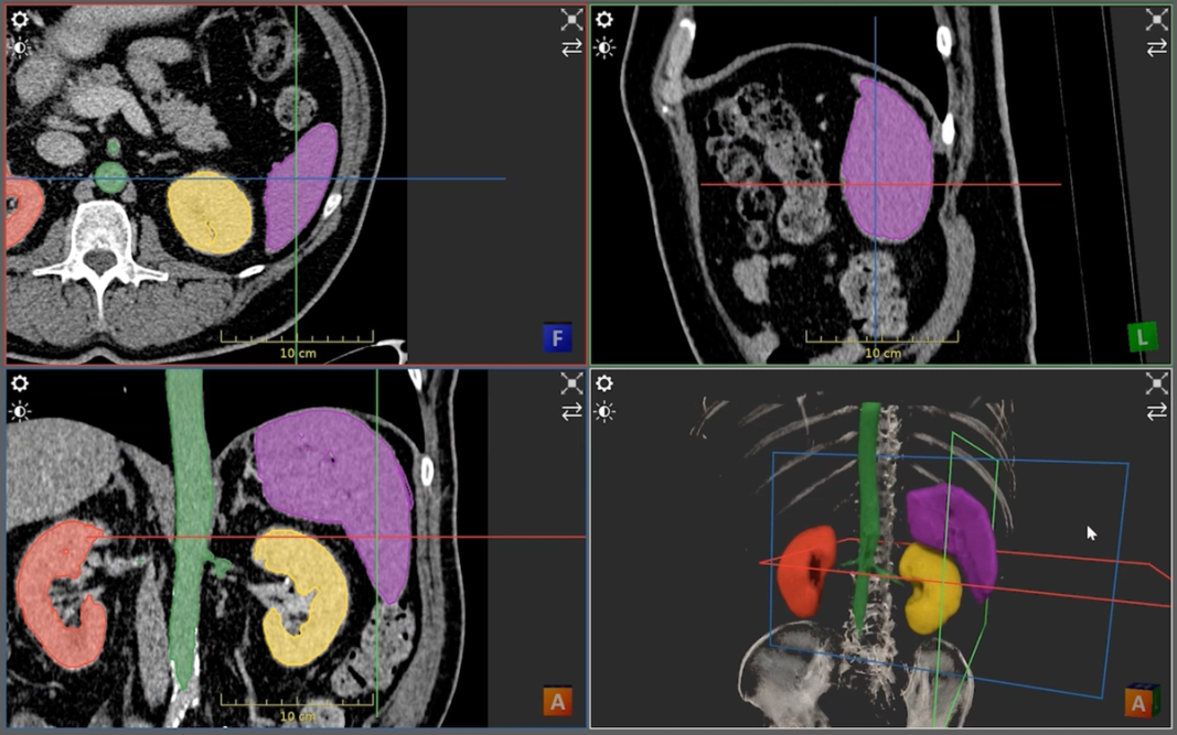 volumetric view of multiple organs segmenting with 3d smart brush