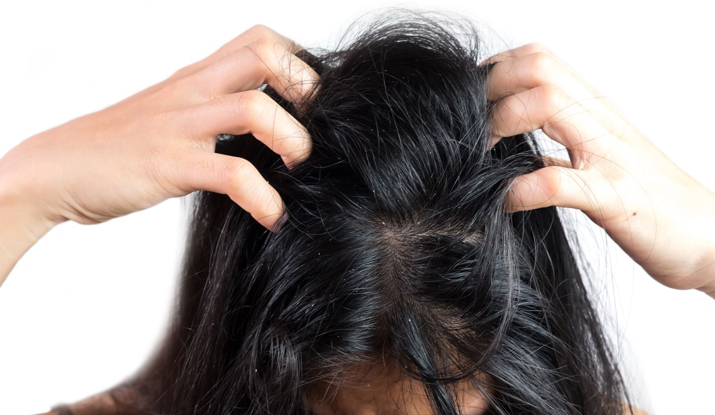 Women Head With Dandruff Caused By The Problem Of Dirty. Or Caused By Skin  Disease Or Seborrheic Dermatitis. It Has White Scaly And It Will Cause  Itch. Stock Photo, Picture And Royalty