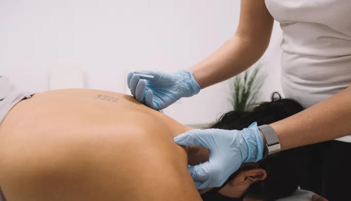 Dry Needling at B3 Physical Therapy in Hallandale Beach