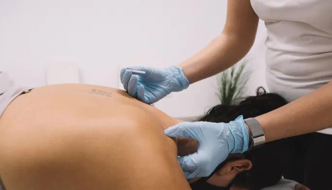 Dry Needling at B3 Physical Therapy in Hallandale Beach
