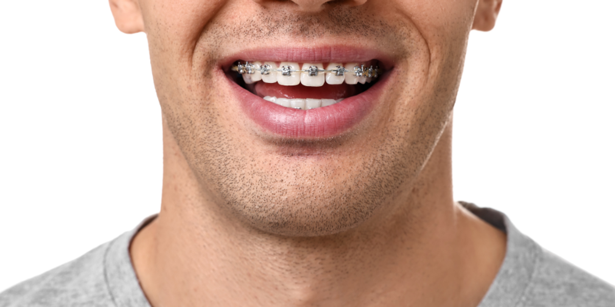 7 Adult Braces Myths Debunked