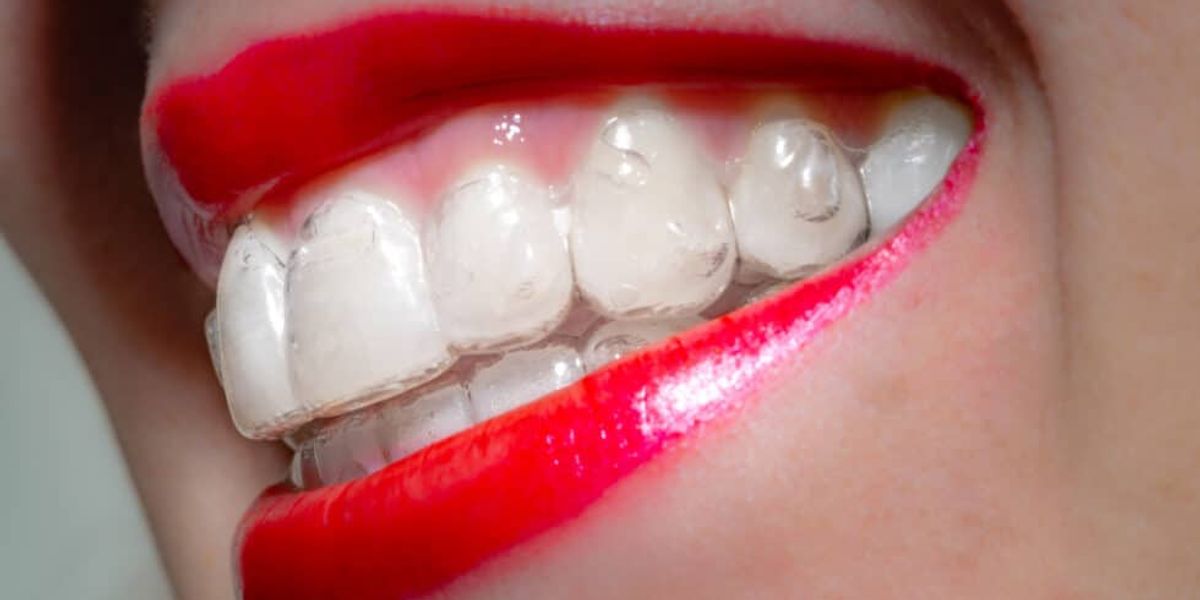 6 Benefits of Adult Invisalign for Achieving the Perfect Smile
