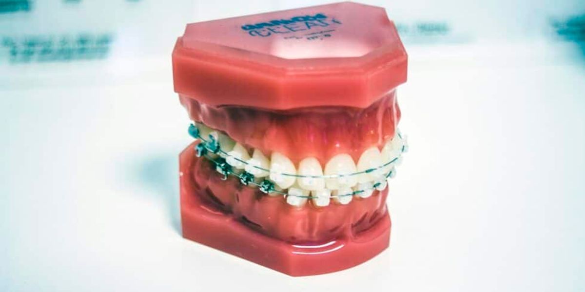 Do Ceramic Braces Stain? Find Out How to Avoid Discoloration