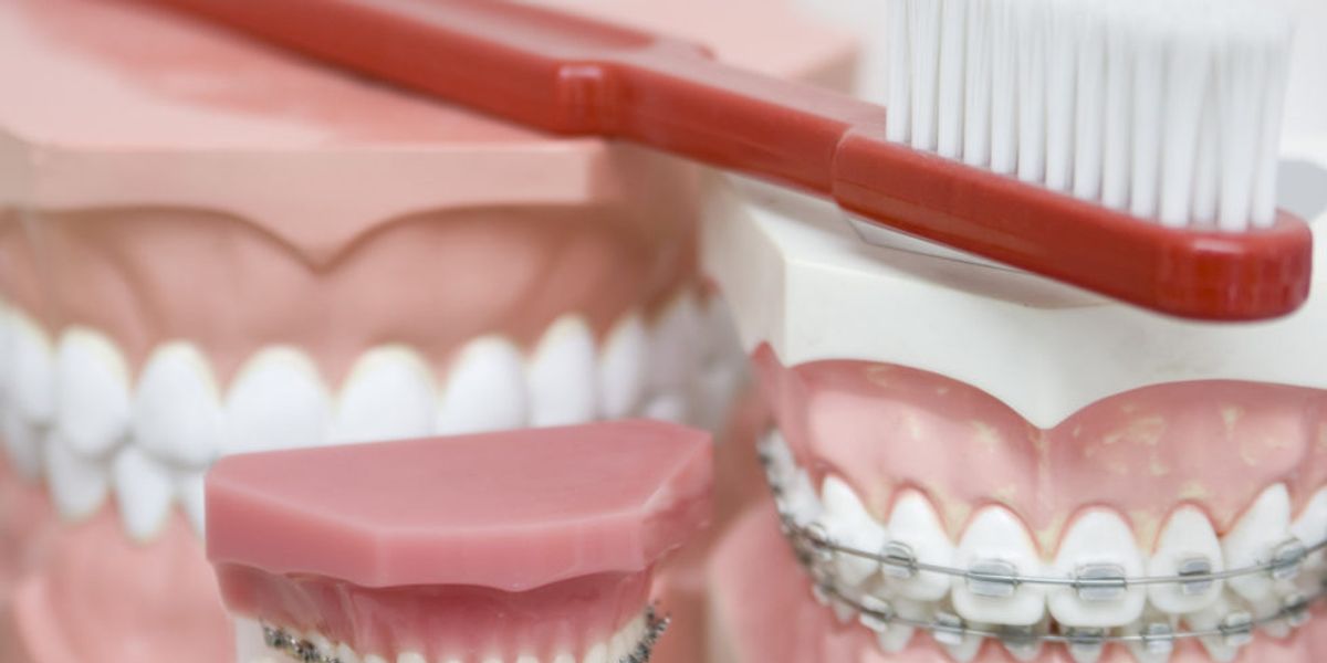 Securing Your Smile: Everything You Need to Know About Adult Braces