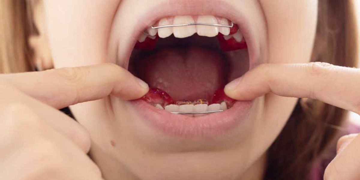 What Are the Benefits of Early Orthodontic Treatment?