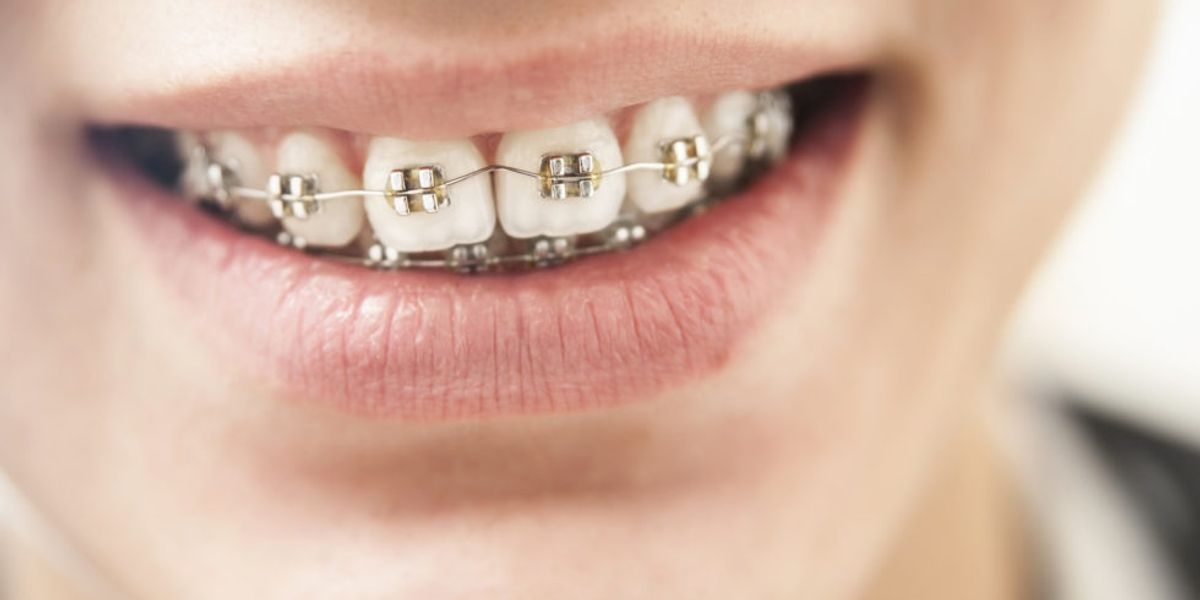 What Age Do Kids Get Braces? How to Tell If Your Child Needs Braces