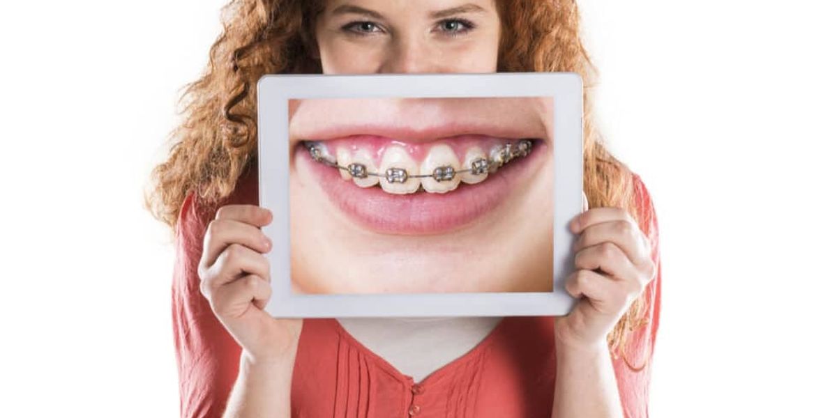 Braces Timeline: How Long Will Your Perfect Smile Take?